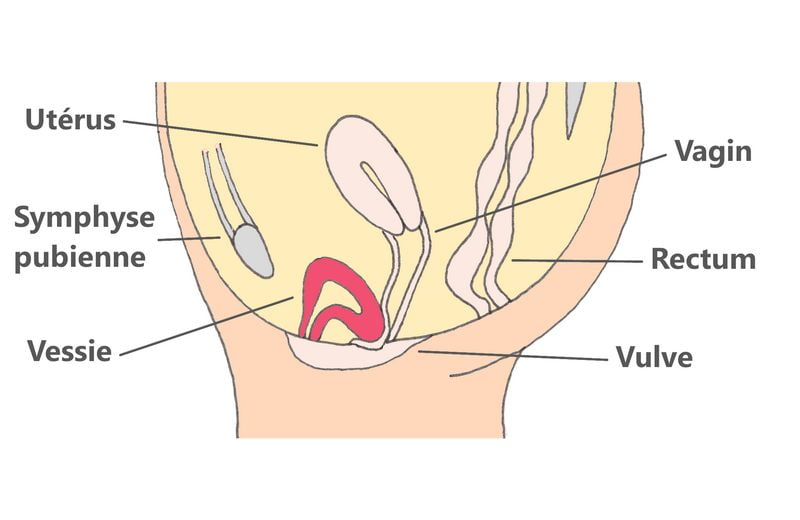 Cystocele